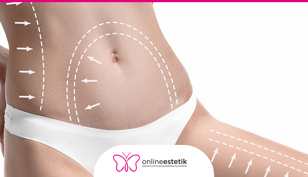 Liposuction Yağ Alma Ameliyatı Nasıl Yapılmaktadır